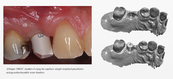 TRIOS with implant scanning